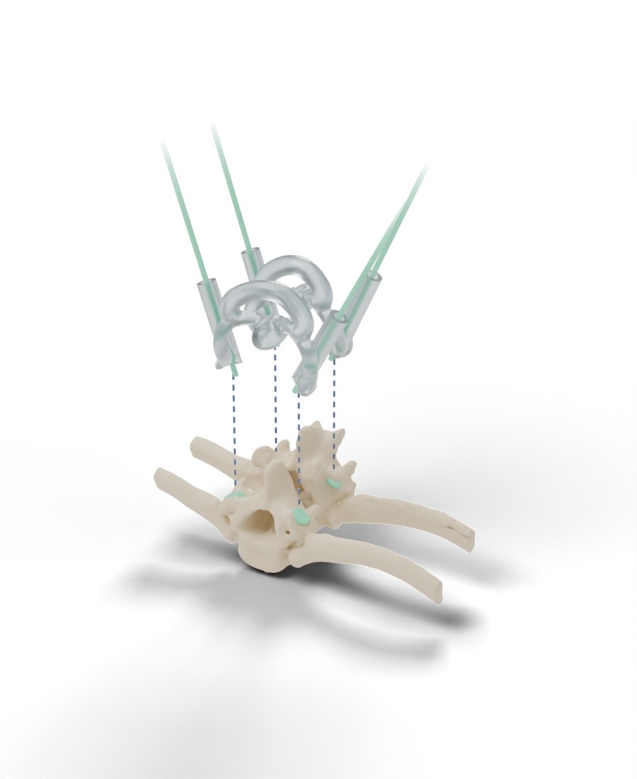 Exploded view: the guide lifted above the vertebrae, with dashed lines showing where its contact points seat