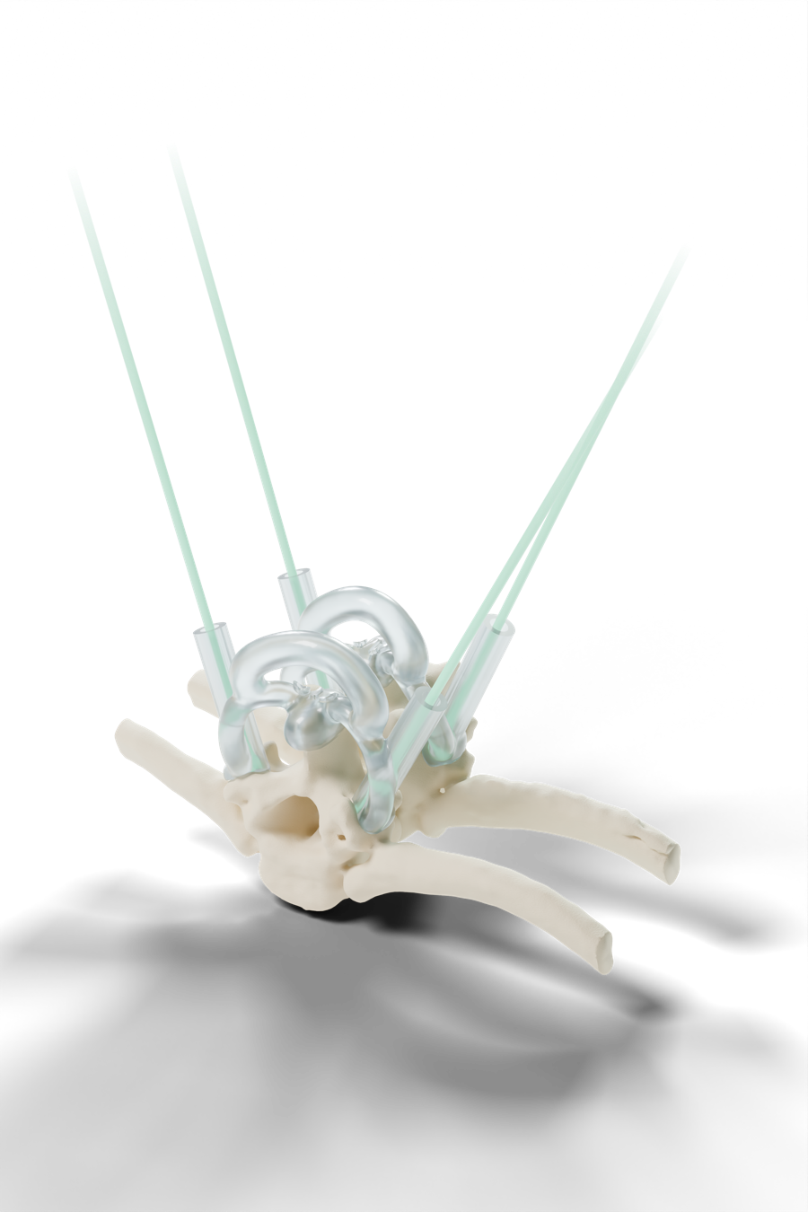 Patient-specific pedicle screw drill guide seated on a thoracolumbar vertebral segment, with four drill sleeves and planned trajectories