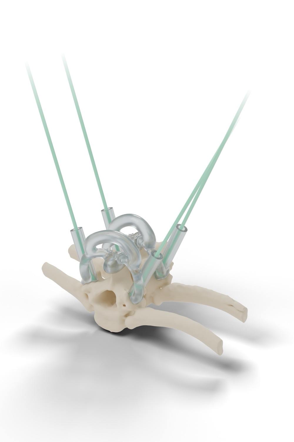Patient-specific pedicle screw drill guide seated on a thoracolumbar vertebral segment, with four drill sleeves and planned trajectories
